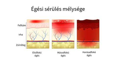 gyermek égési sérülés elsősegély hűtése