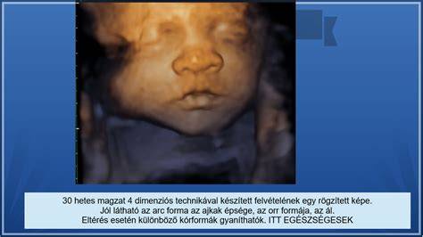 Magzati arc 3D ultrahang felvételen